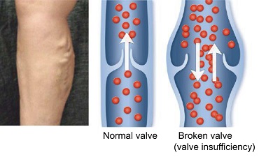 Varicose Veins – 牧港中央病院-English