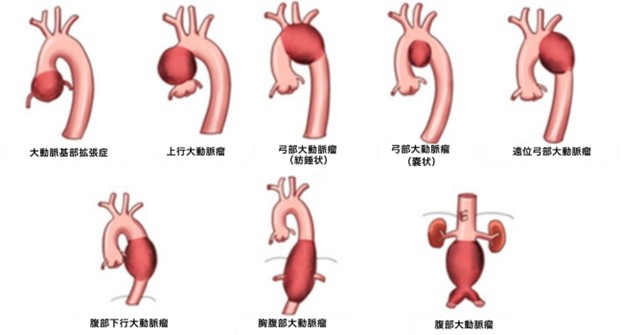 大動脈瘤とは